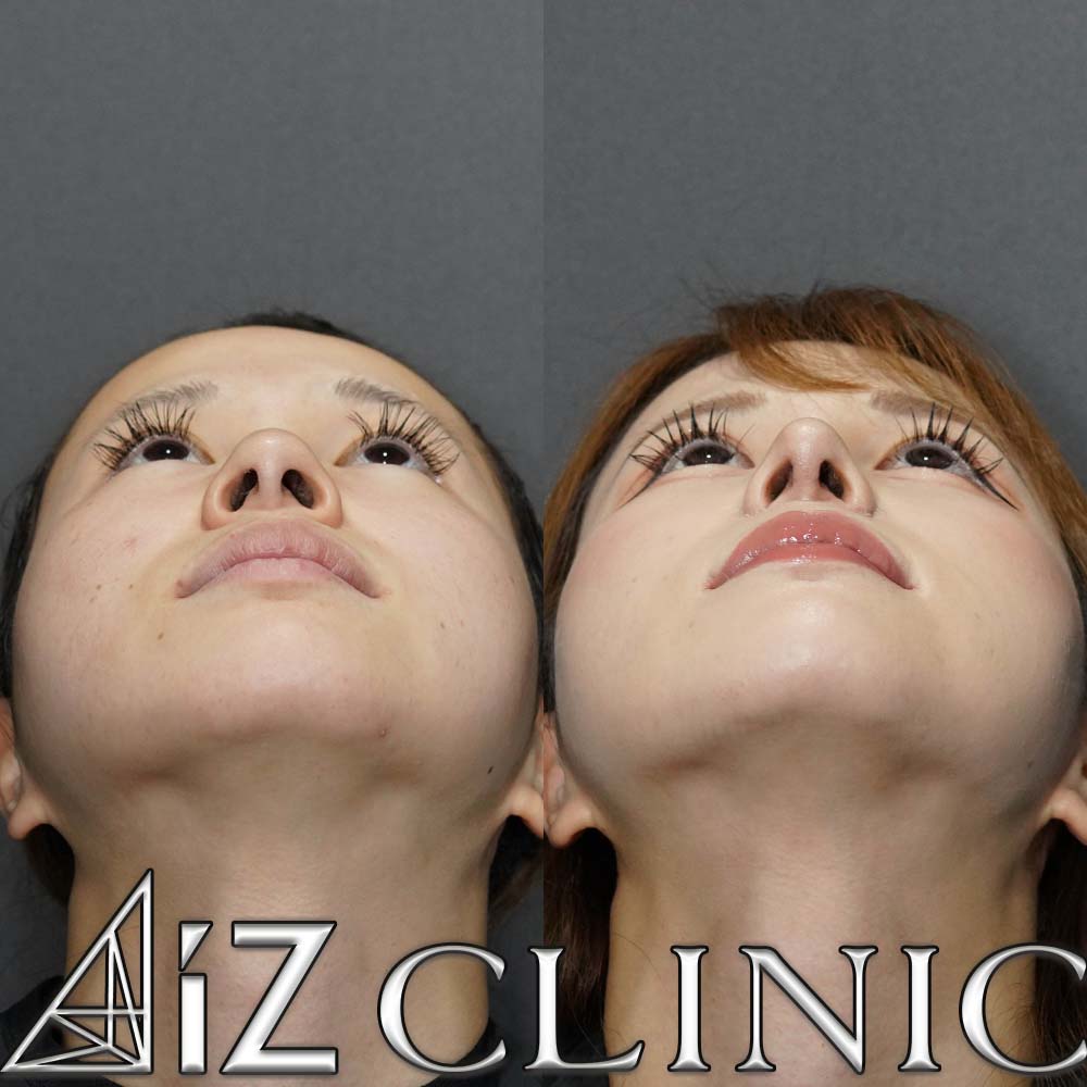 鼻翼基部に高さの差がある症例