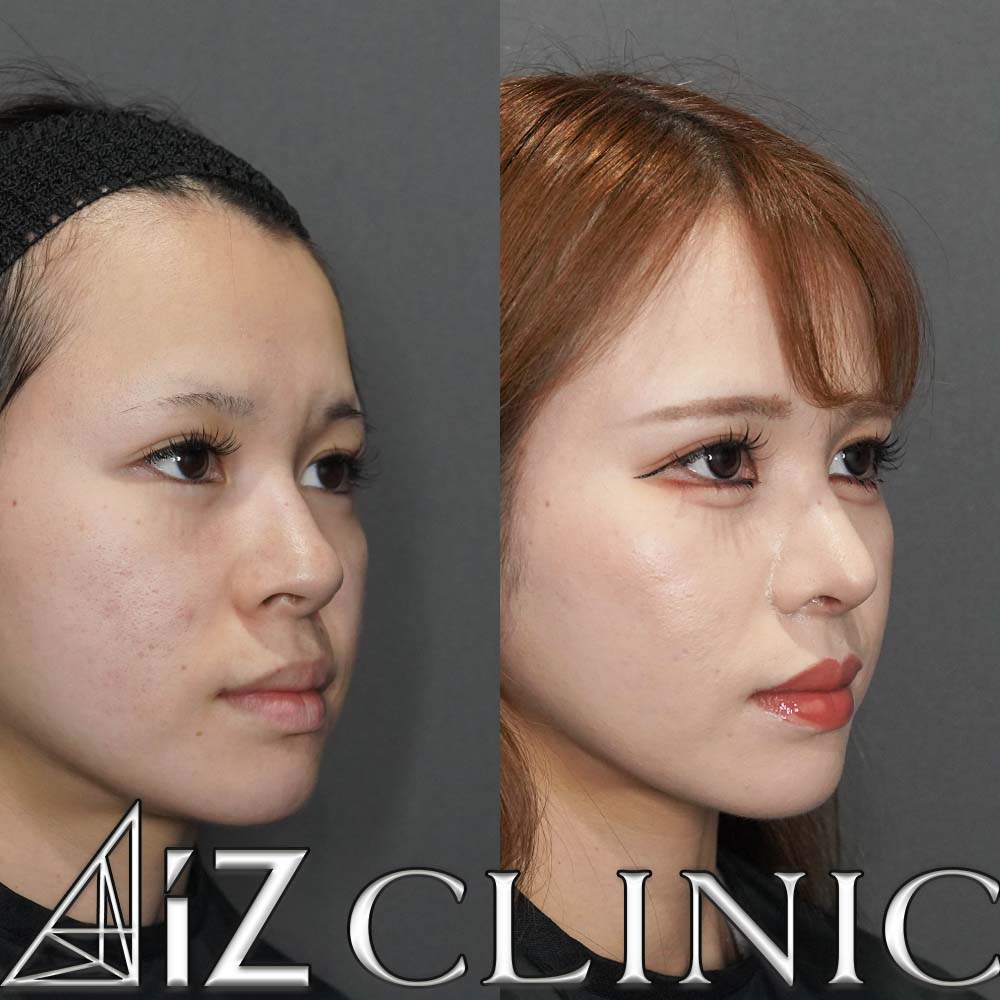 鼻翼基部に高さの差がある症例