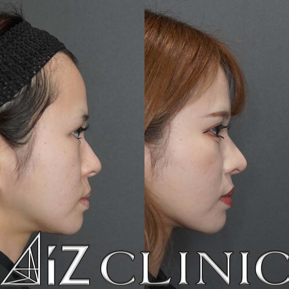 鼻翼基部に高さの差がある症例