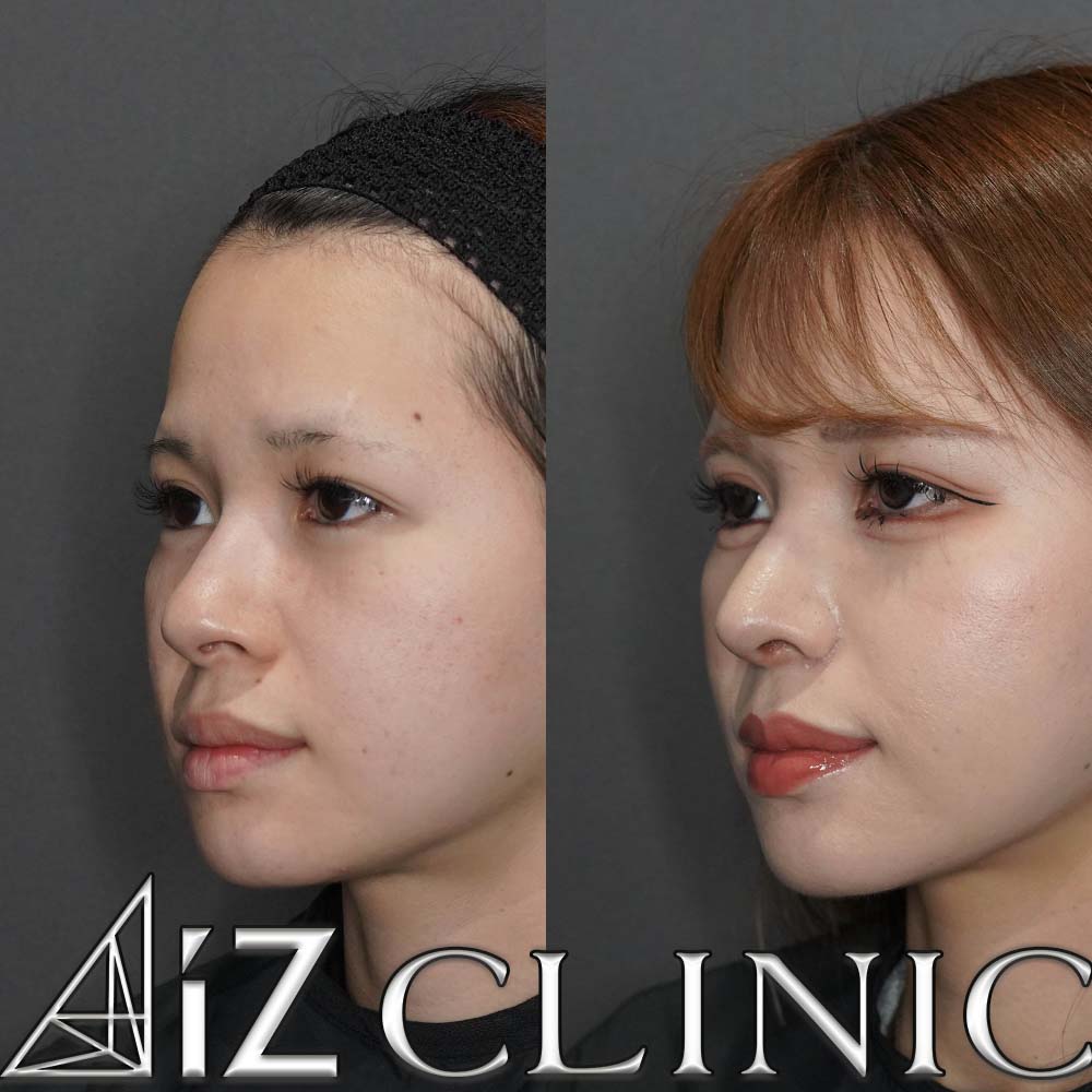 鼻翼基部に高さの差がある症例