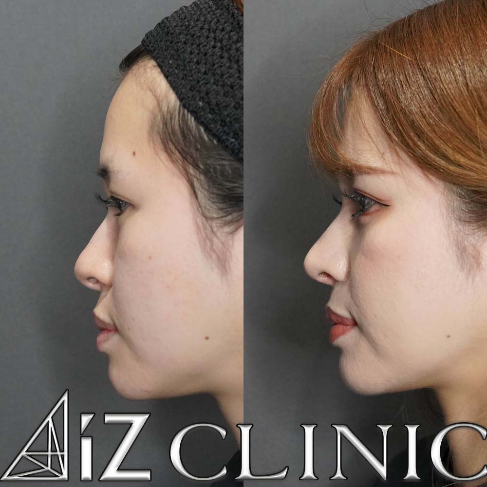 鼻翼基部に高さの差がある症例