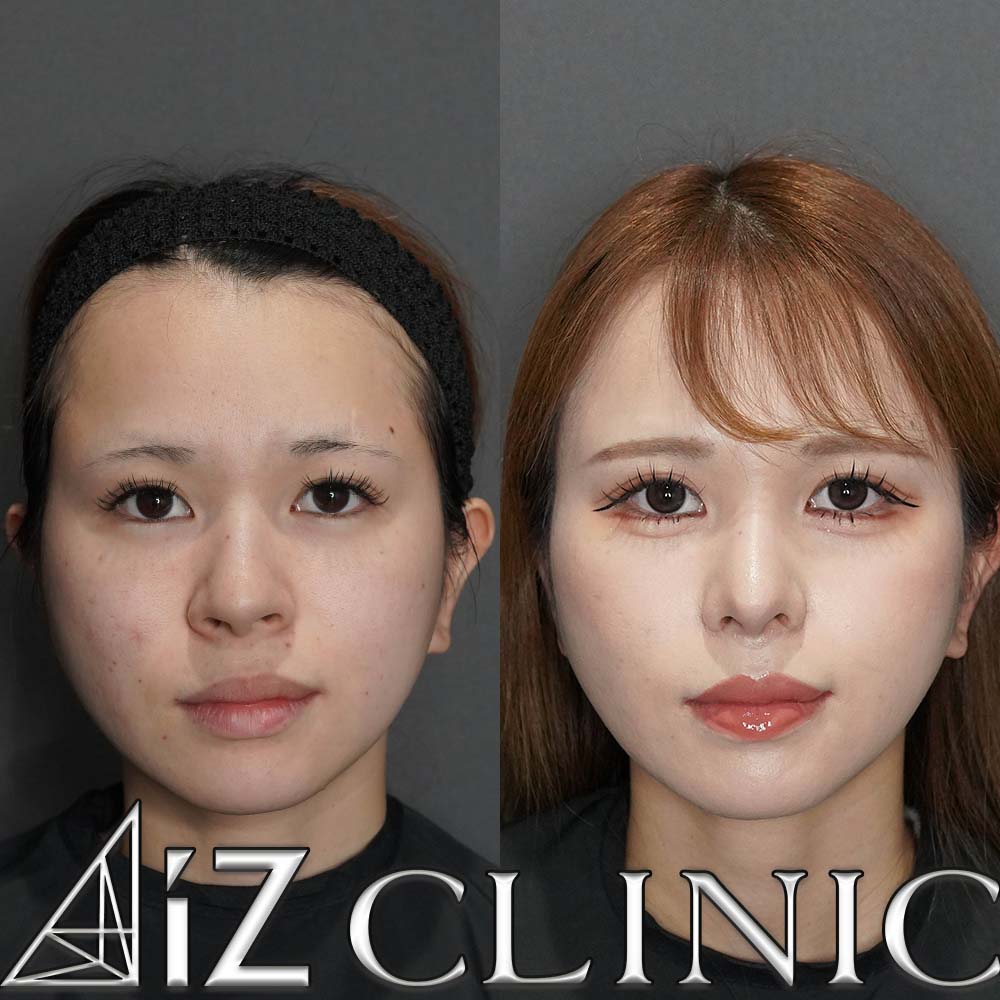 鼻翼基部に高さの差がある症例