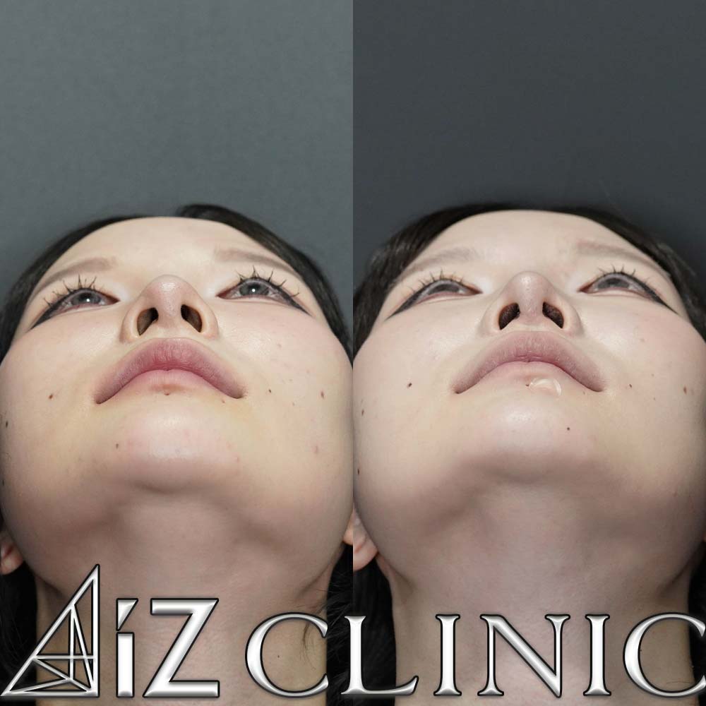 鷲鼻修正の一例