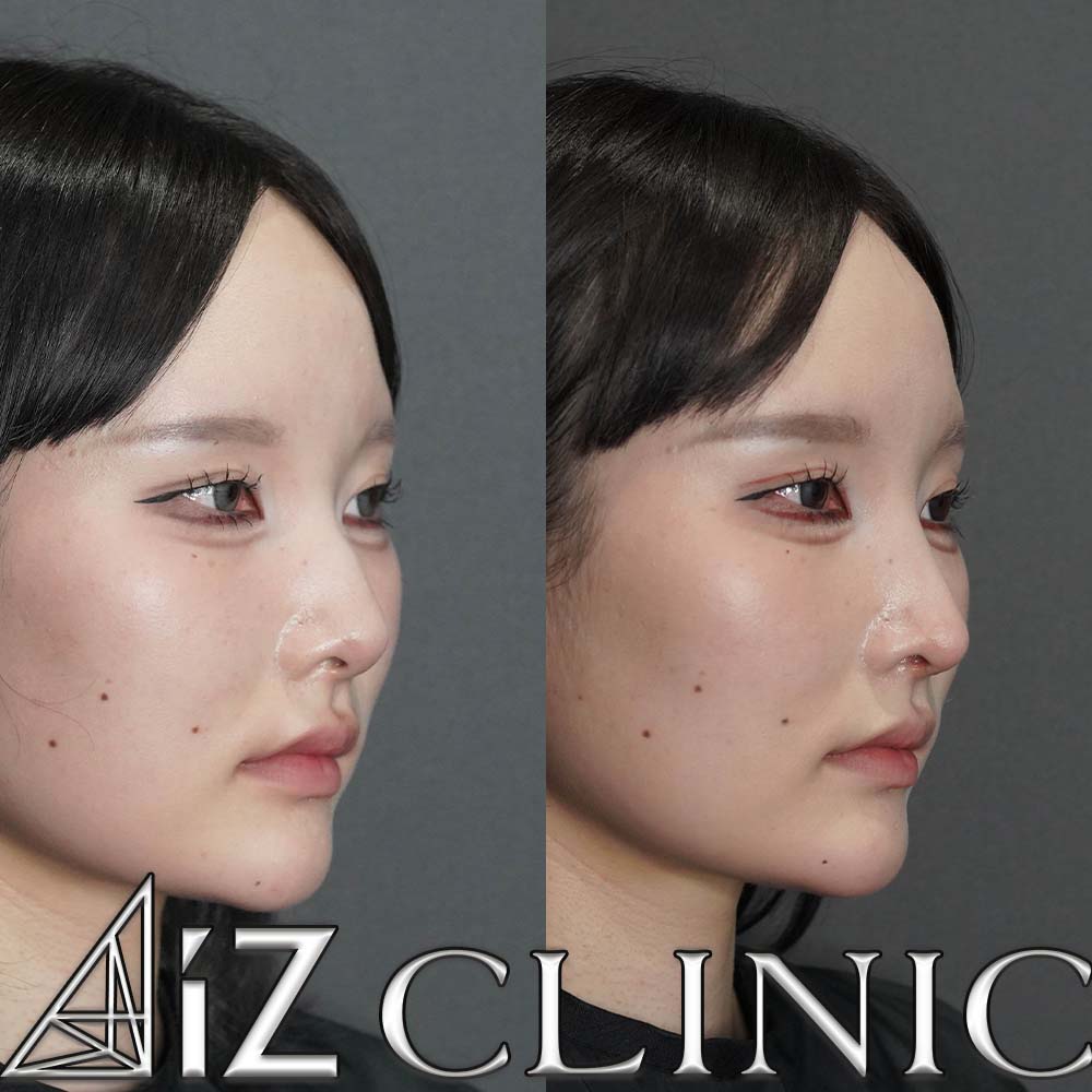 鷲鼻修正の一例