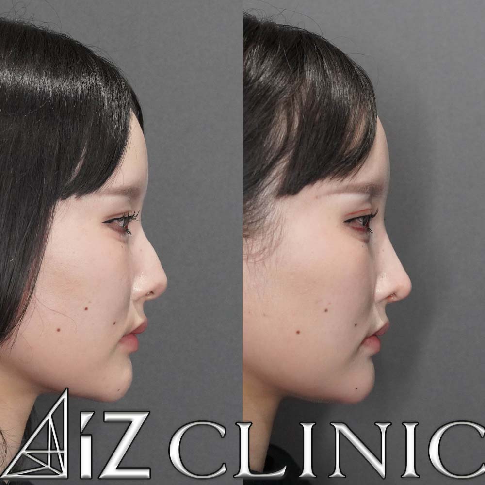 鷲鼻修正の一例