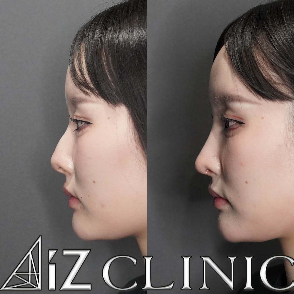 鷲鼻修正の一例