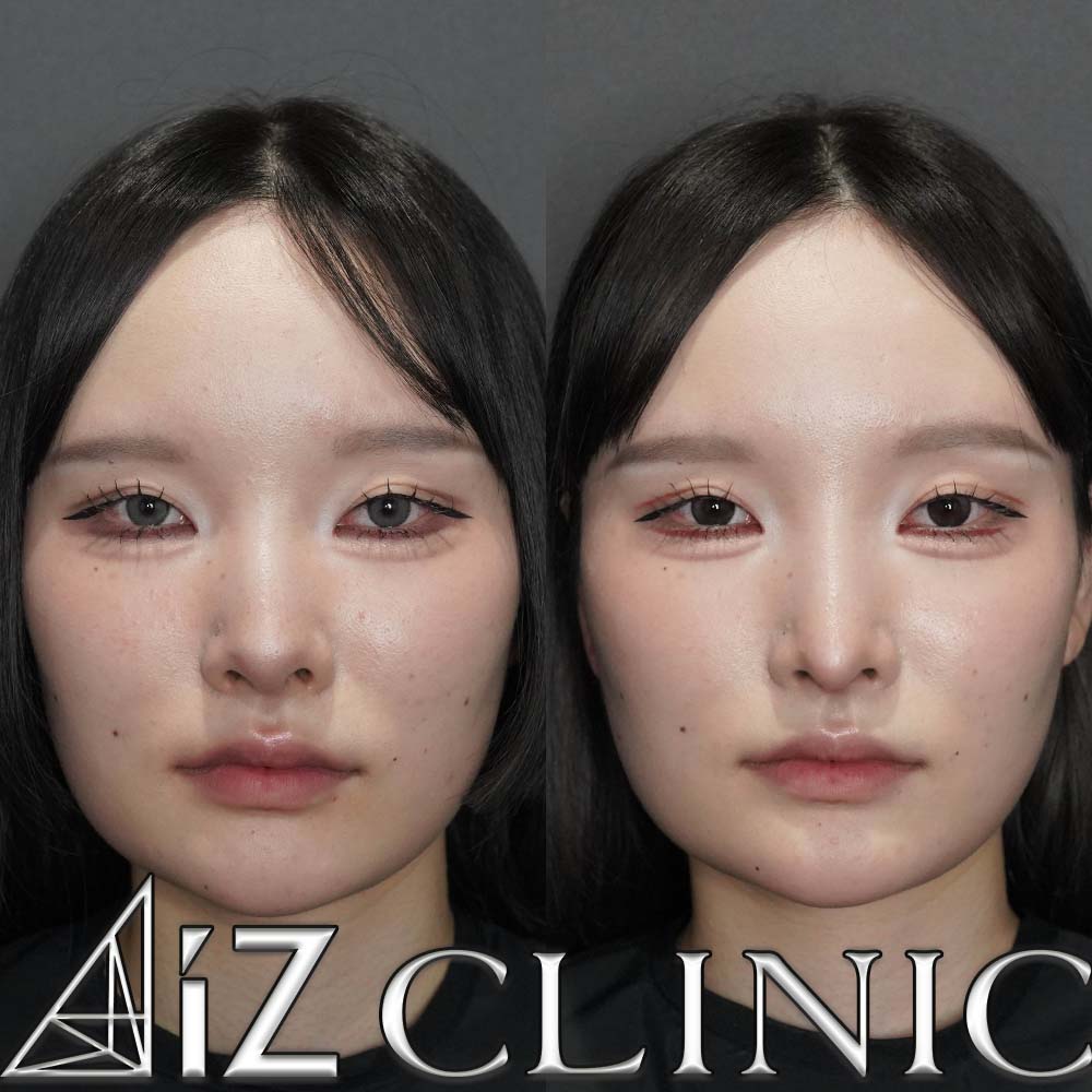 鷲鼻修正の一例