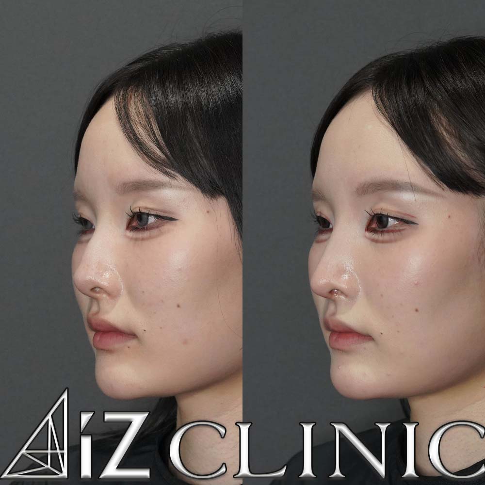 鼻尖形成ストラット法、軟骨移植、鼻中隔延長、鷲鼻修正の術後1ヶ月