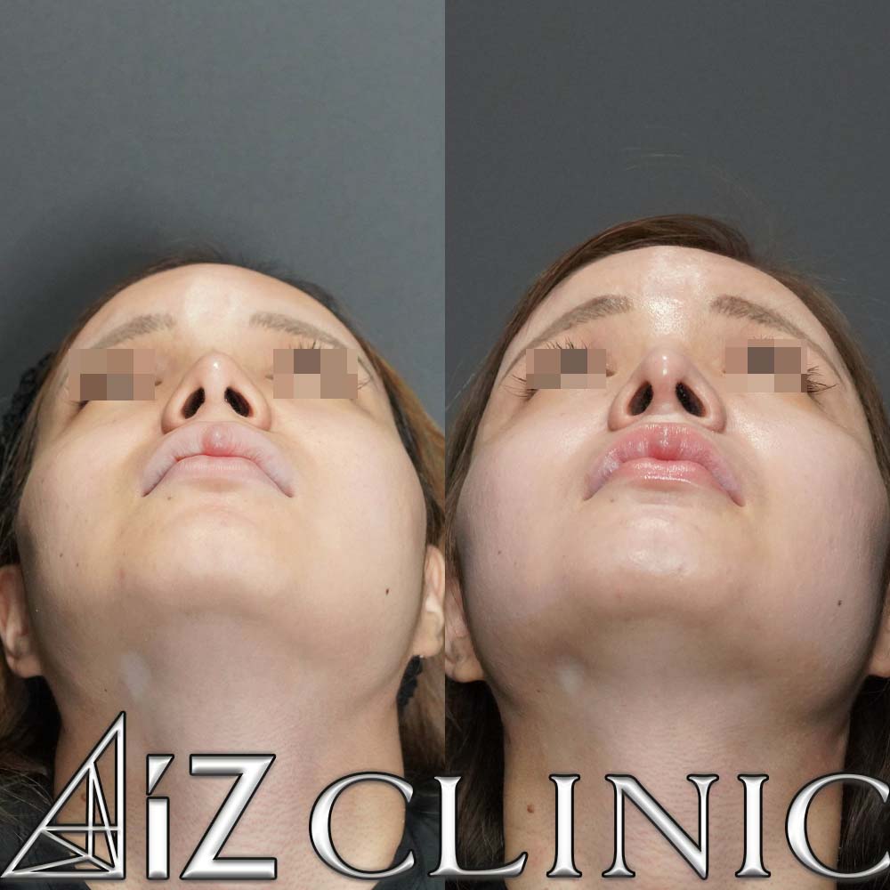 鼻中隔延長で綺麗な忘れ鼻に