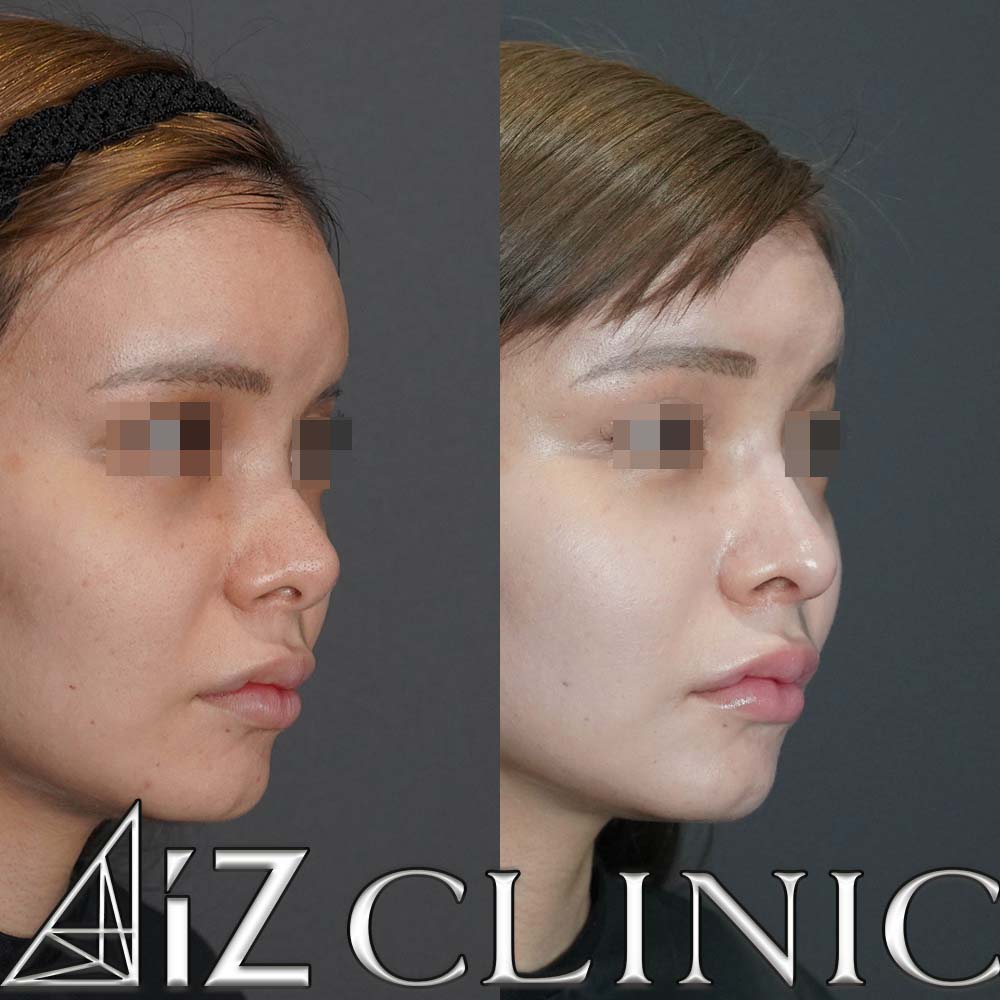 鼻中隔延長で綺麗な忘れ鼻に