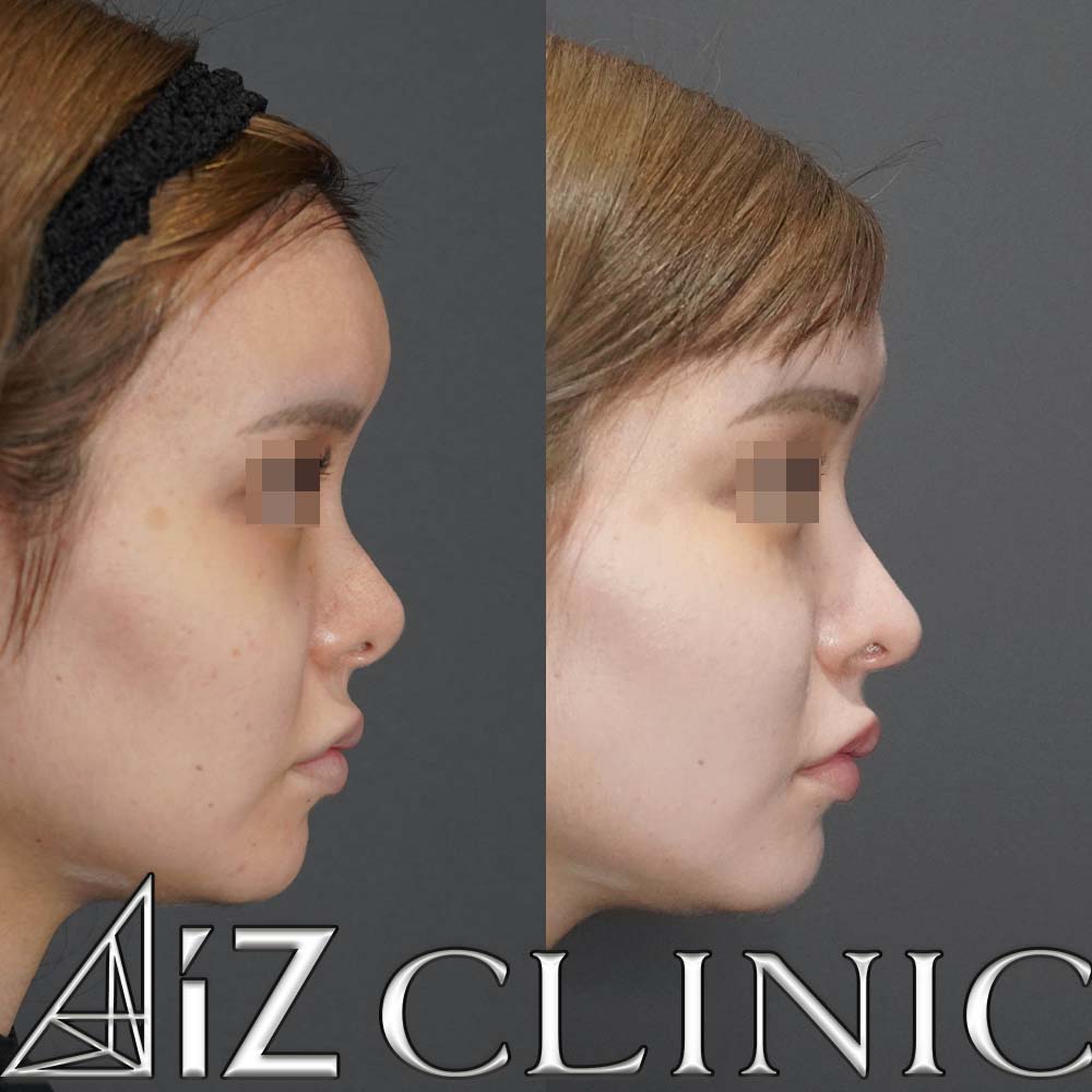 鼻中隔延長で綺麗な忘れ鼻に