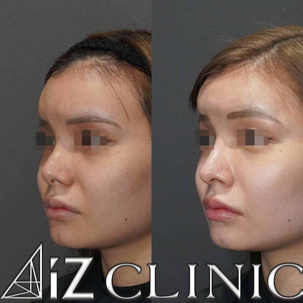 鼻中隔延長で綺麗な忘れ鼻に