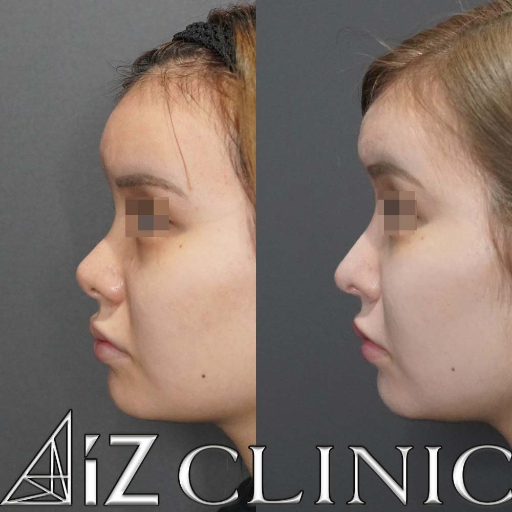 鼻中隔延長で綺麗な忘れ鼻に