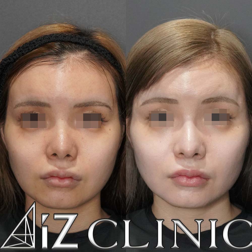 鼻尖形成ストラット法、軟骨移植、鼻中隔延長、プロテーゼの術後3ヶ月