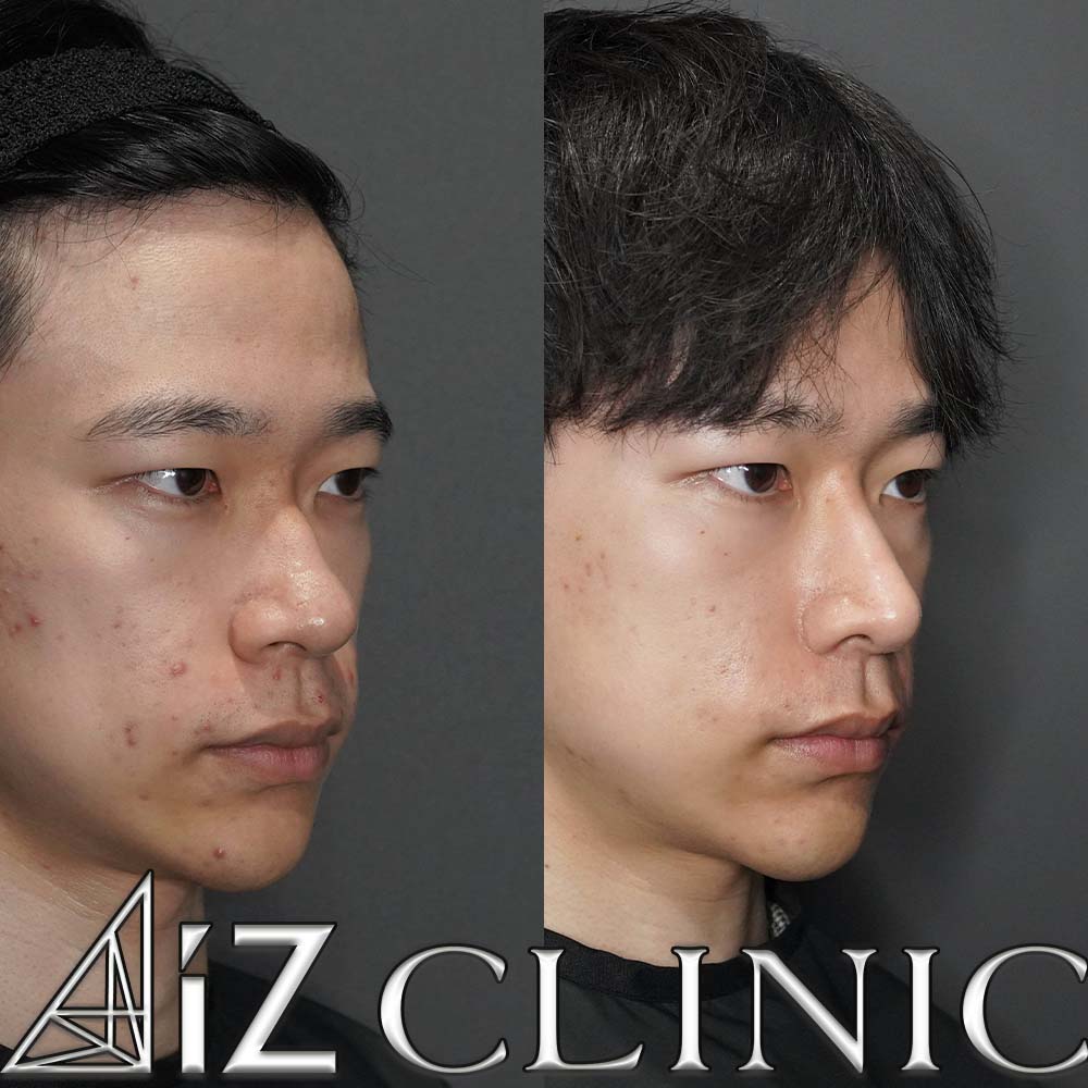 鼻尖形成ストラット法、軟骨移植、鼻中隔延長、鷲鼻修正、小鼻縮小、プロテーゼの術後1ヶ月