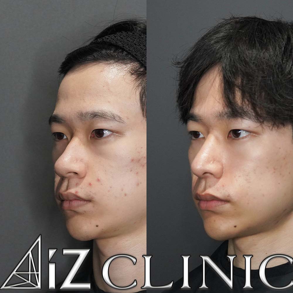 鼻尖形成ストラット法、軟骨移植、鼻中隔延長、鷲鼻修正、小鼻縮小、プロテーゼの術後1ヶ月