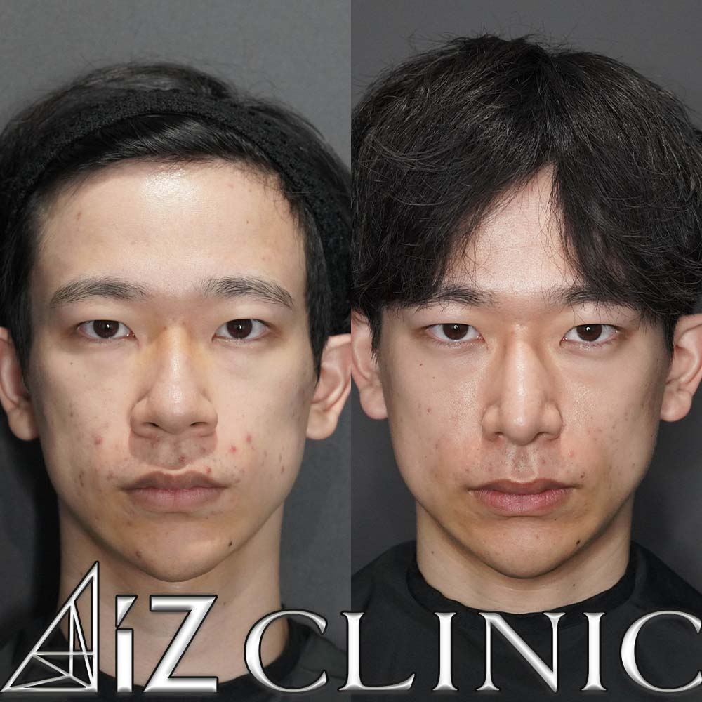 鼻尖形成ストラット法、軟骨移植、鼻中隔延長、鷲鼻修正、小鼻縮小、プロテーゼの術後1ヶ月