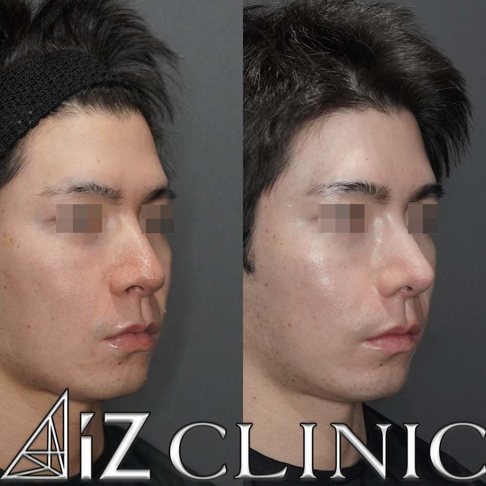 格好良さを追求したメンズ鼻症例