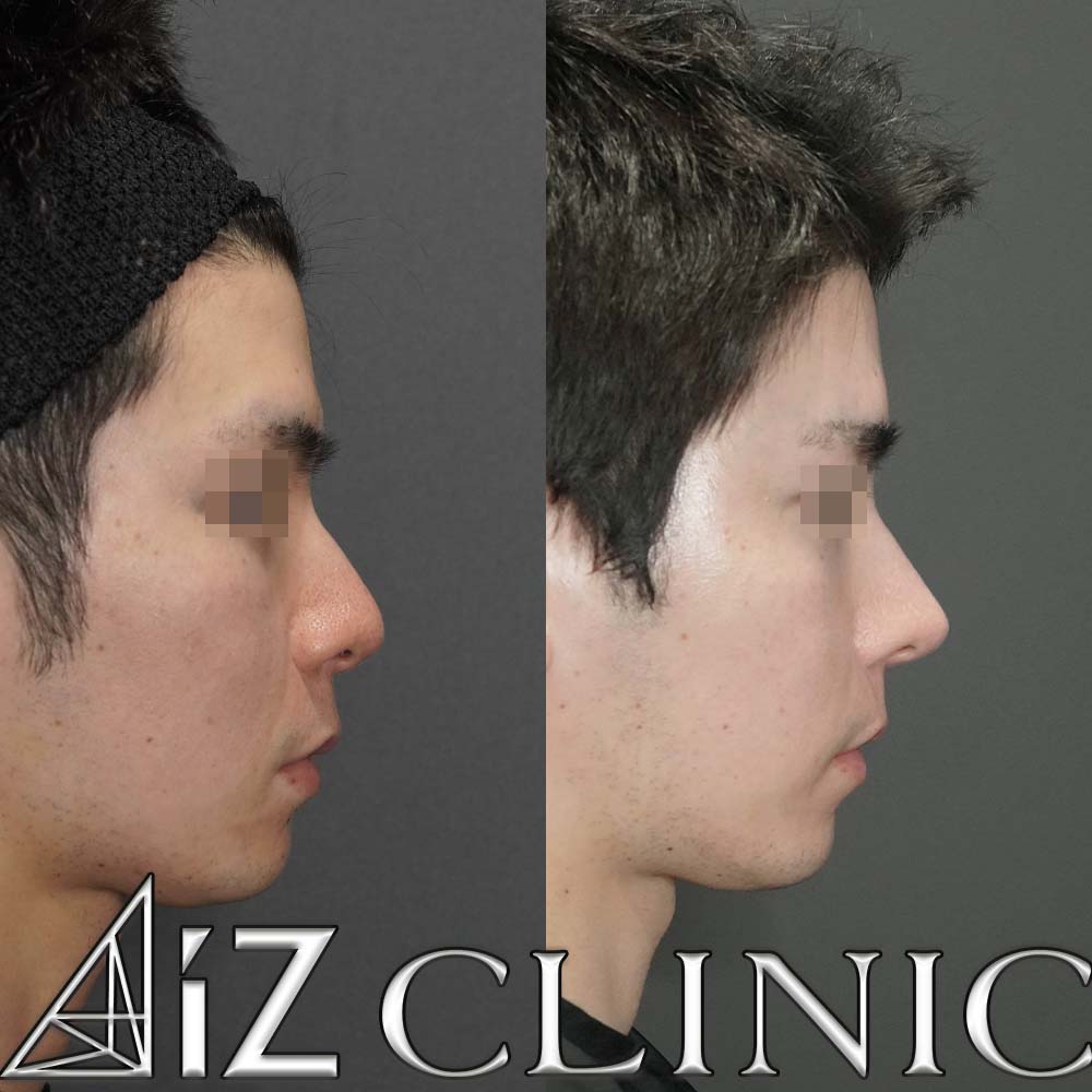 格好良さを追求したメンズ鼻症例