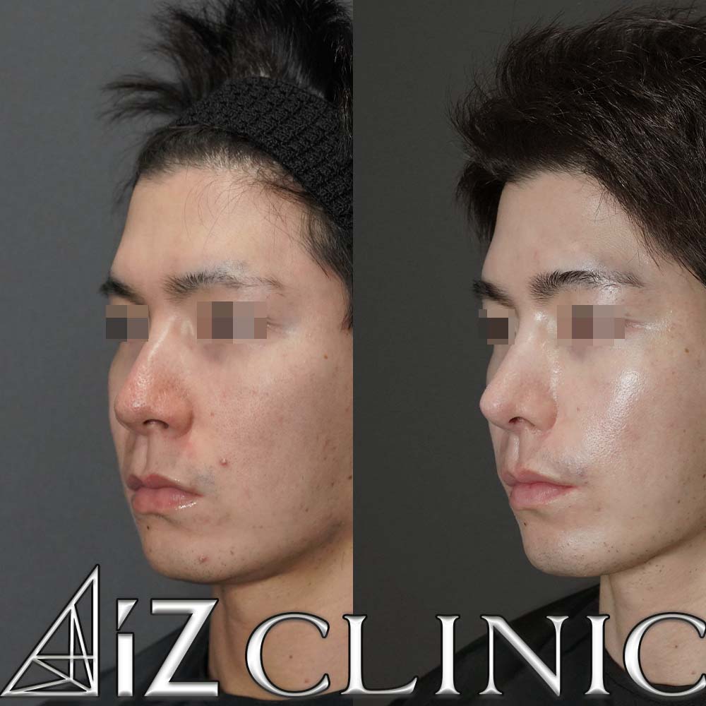 格好良さを追求したメンズ鼻症例