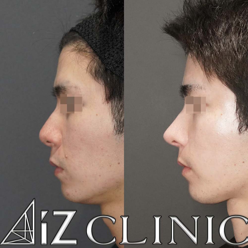 格好良さを追求したメンズ鼻症例