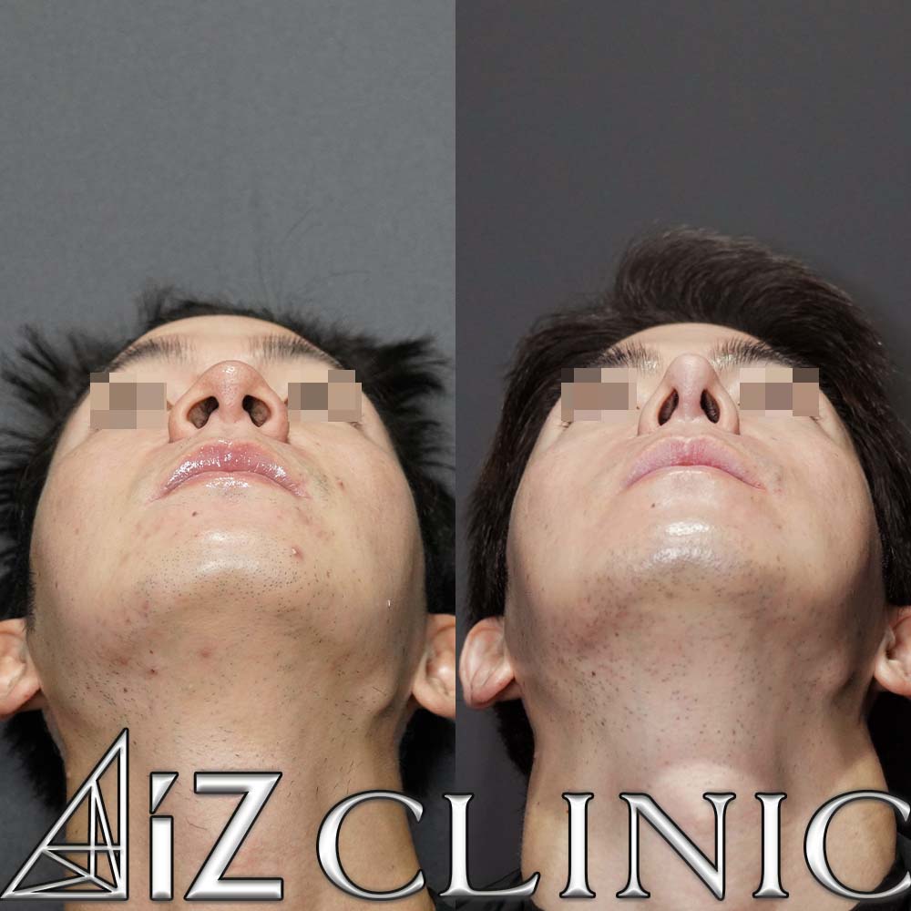 鼻尖形成ストラット法、軟骨移植、鼻中隔延長、小鼻縮小の術後6ヶ月