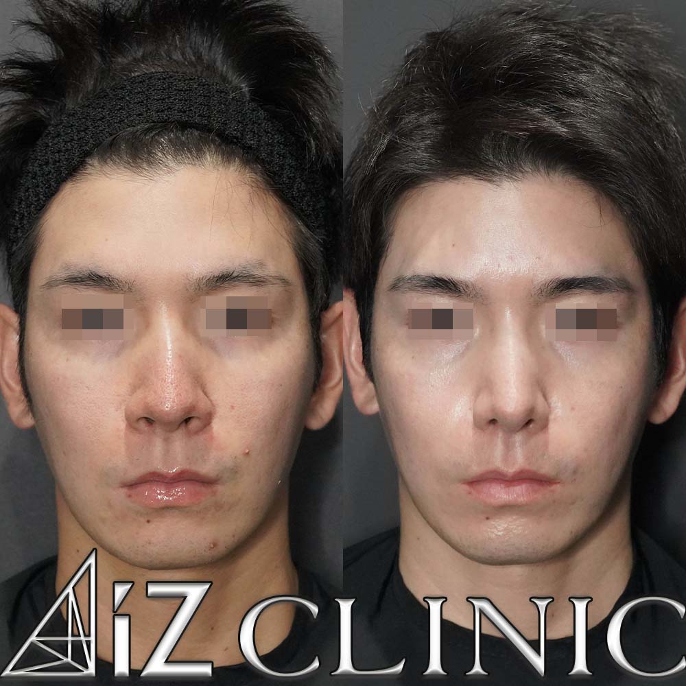 鼻尖形成ストラット法、軟骨移植、鼻中隔延長、小鼻縮小の術後6ヶ月