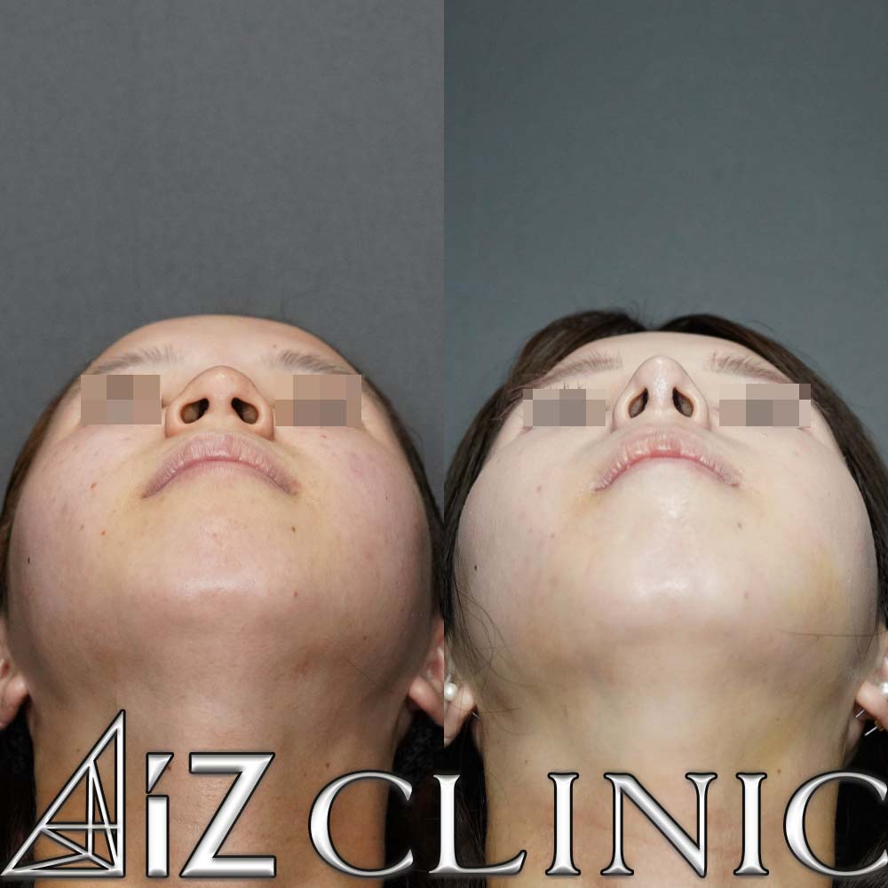 鼻中隔延長、小鼻縮小で鼻の丸みと大きさのコントロールを行なった一例