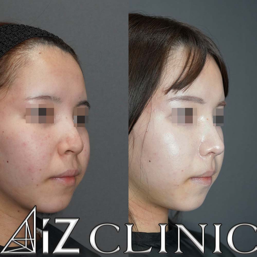 鼻中隔延長、小鼻縮小で鼻の丸みと大きさのコントロールを行なった一例