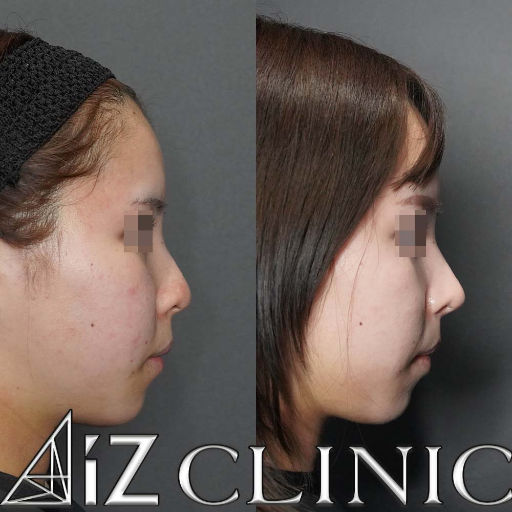 鼻中隔延長、小鼻縮小で鼻の丸みと大きさのコントロールを行なった一例