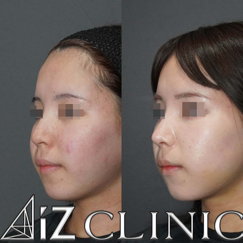 鼻中隔延長、小鼻縮小で鼻の丸みと大きさのコントロールを行なった一例