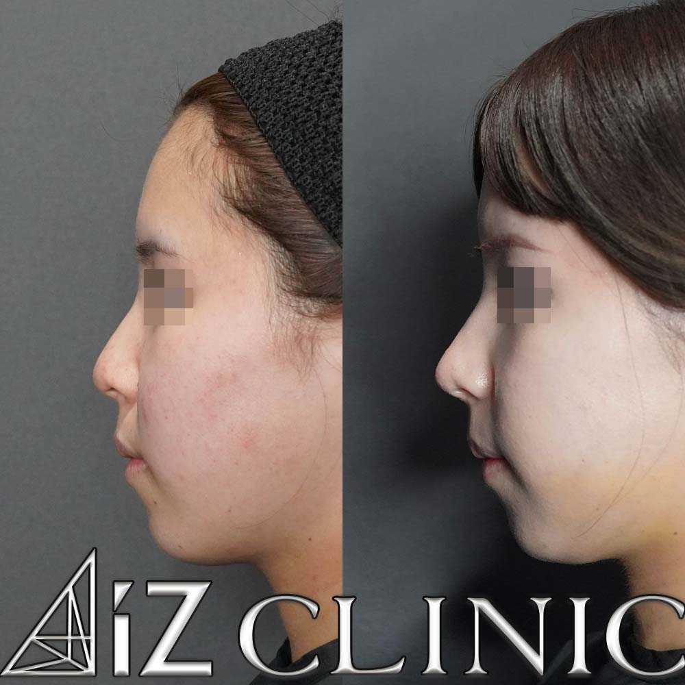 鼻中隔延長、小鼻縮小で鼻の丸みと大きさのコントロールを行なった一例
