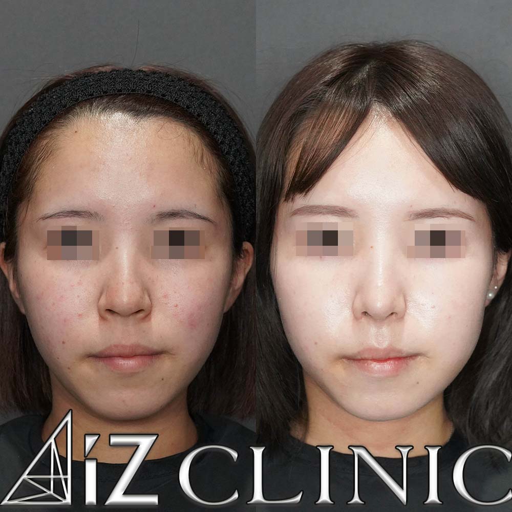 鼻中隔延長、小鼻縮小で鼻の丸みと大きさのコントロールを行なった一例