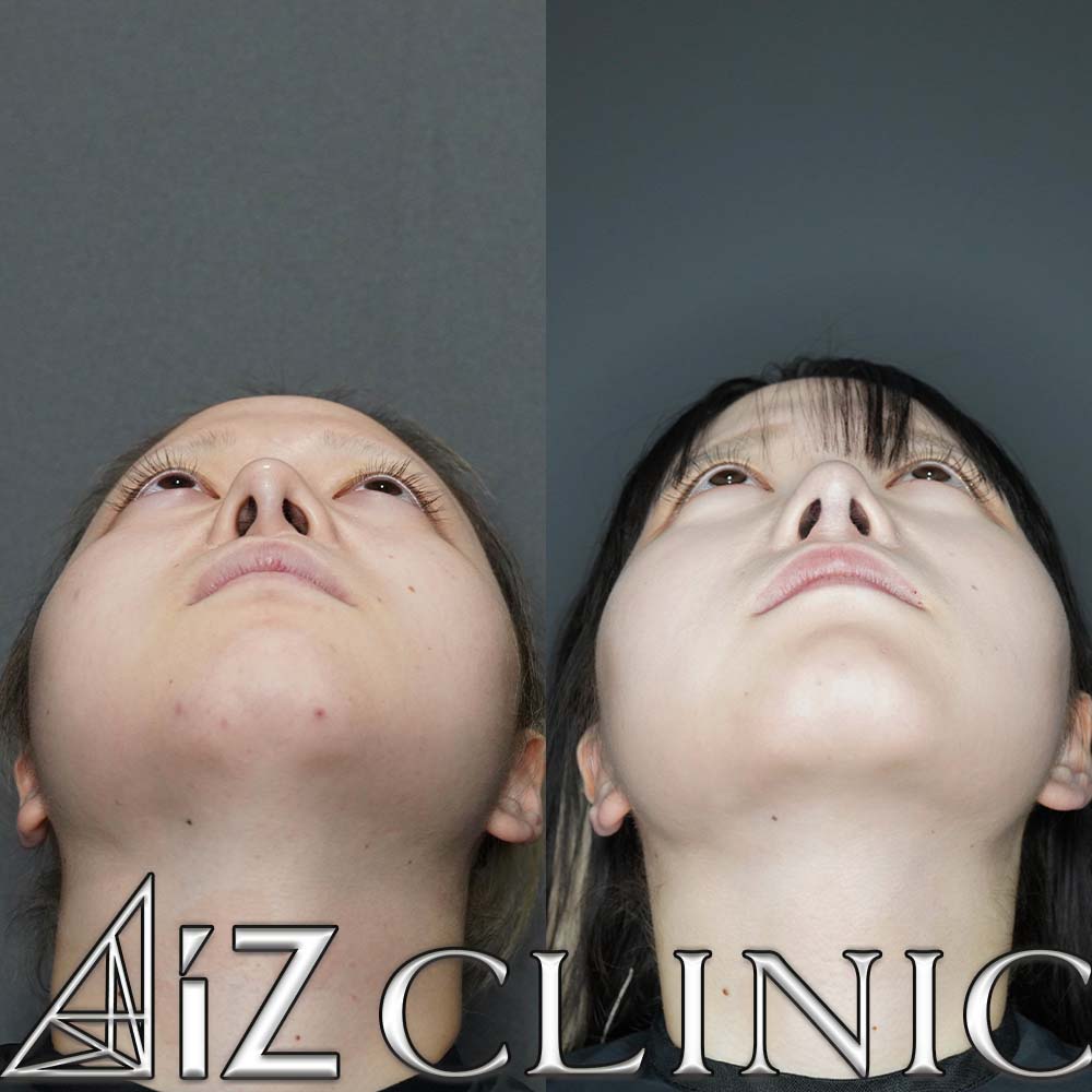 無理な手術で曲がってしまった他院修正の一例