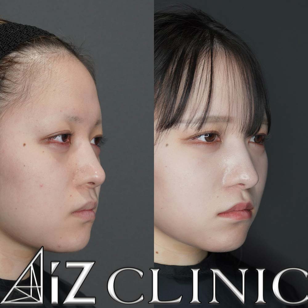 無理な手術で曲がってしまった他院修正の一例