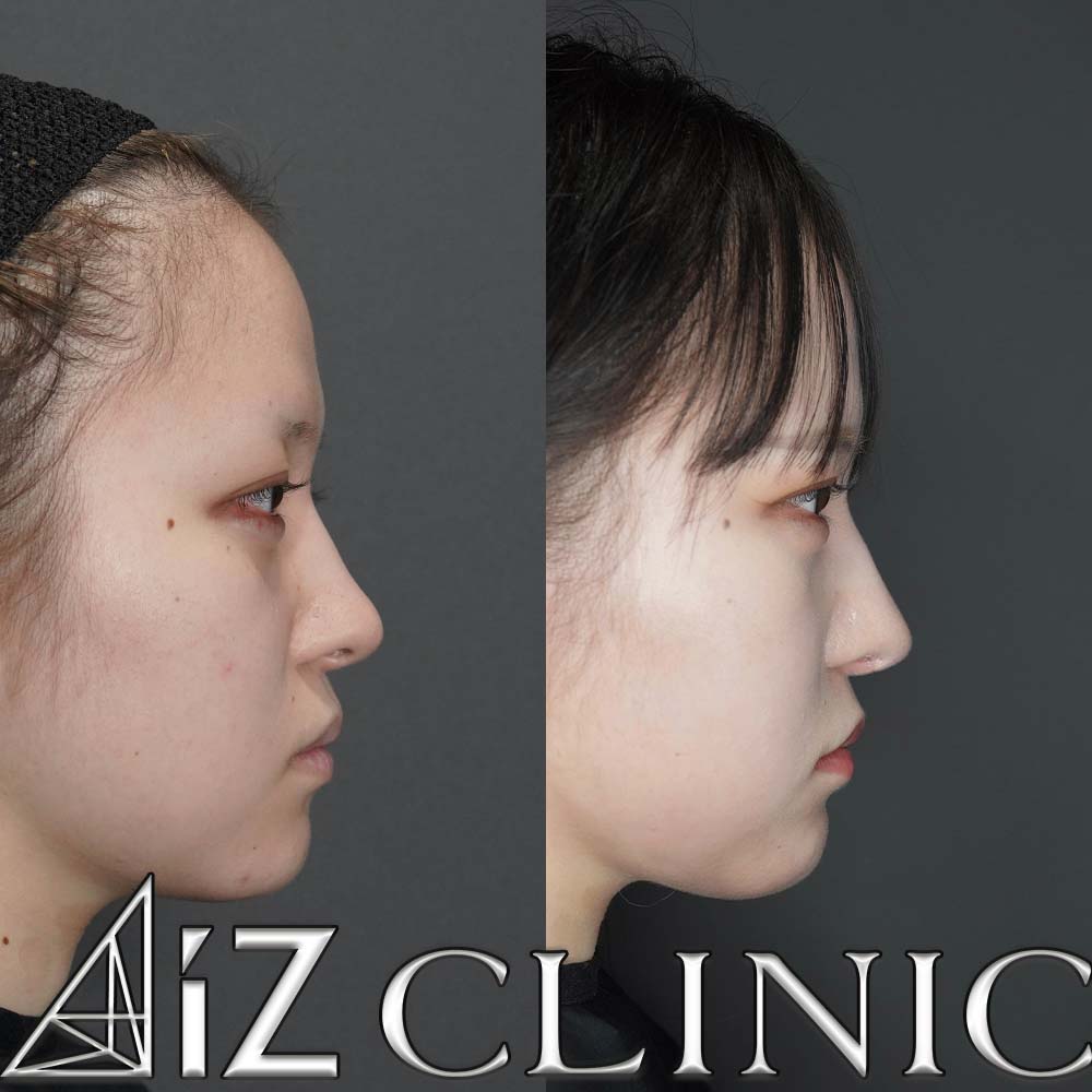 無理な手術で曲がってしまった他院修正の一例