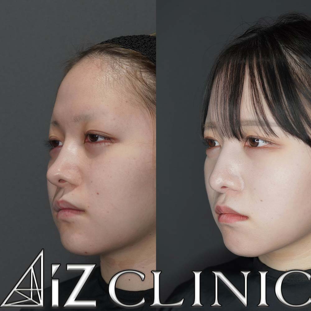 無理な手術で曲がってしまった他院修正の一例