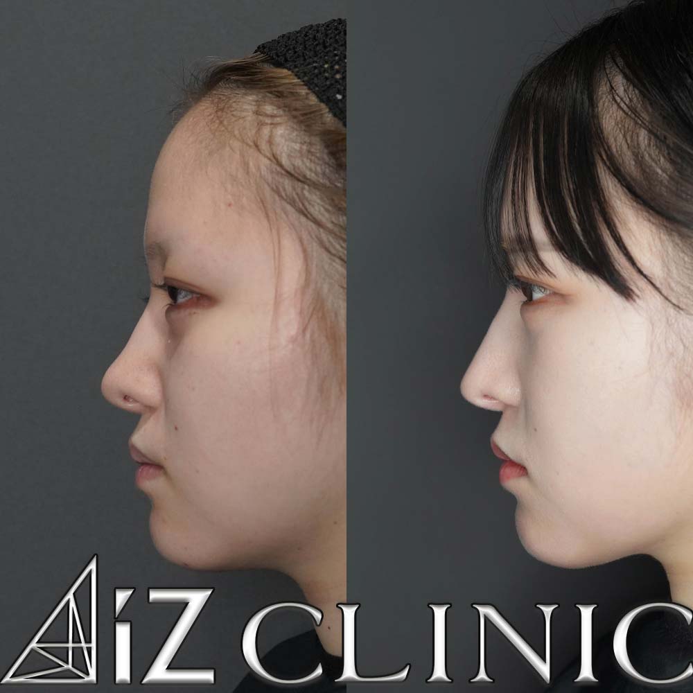 無理な手術で曲がってしまった他院修正の一例