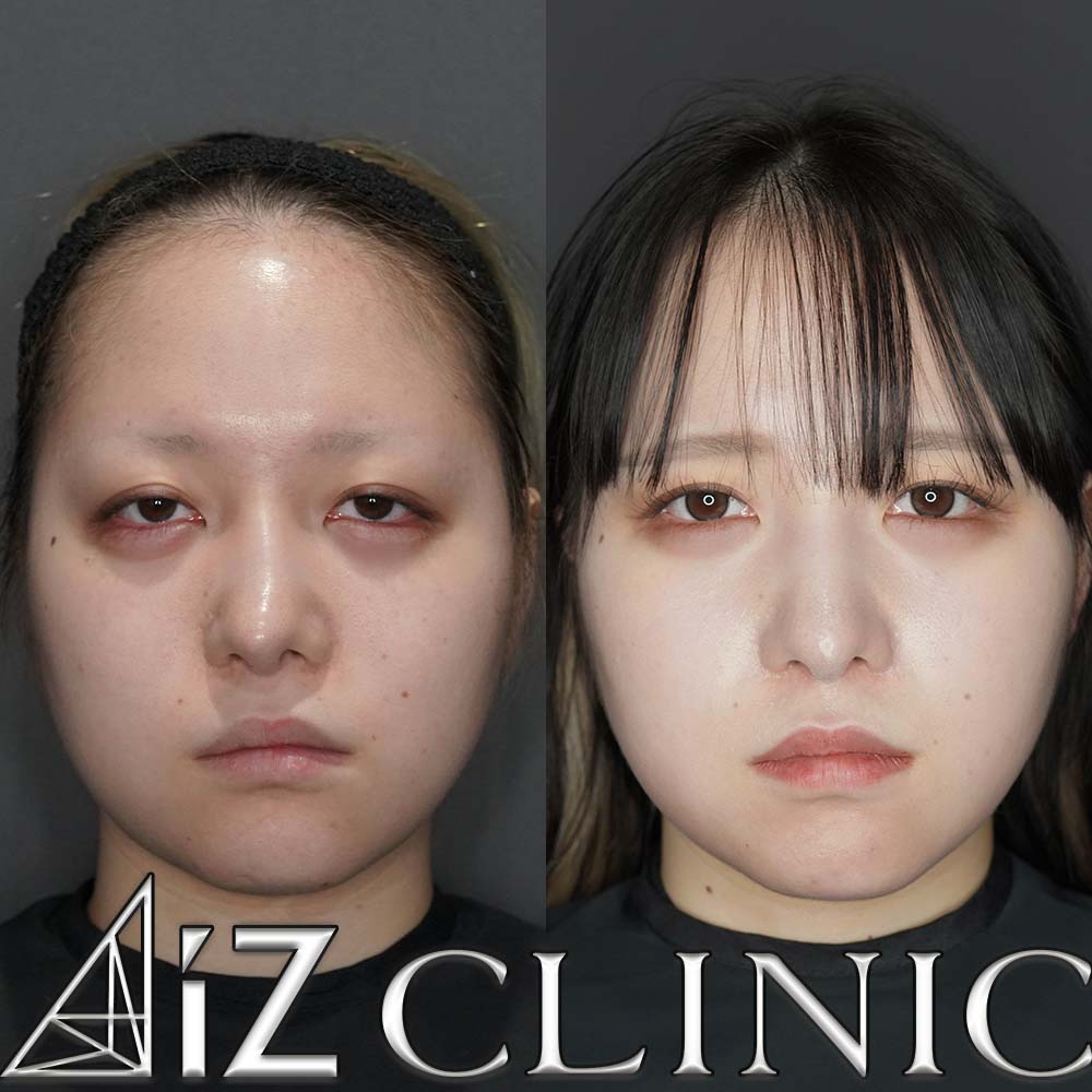 無理な手術で曲がってしまった他院修正の一例