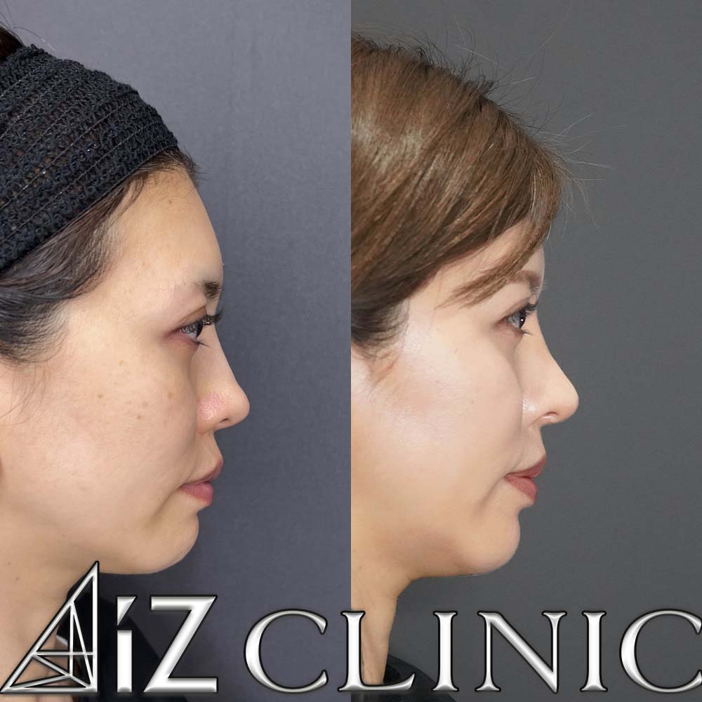 人工真皮を利用したオステオポールの修正手術