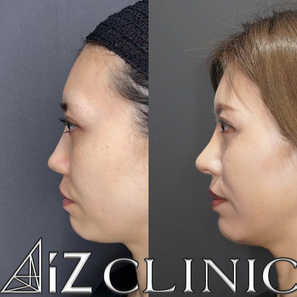 人工真皮を利用したオステオポールの修正手術