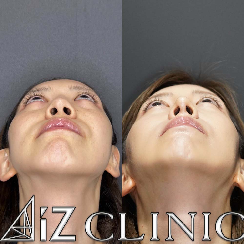 鼻尖形成ストラット法、軟骨移植、鼻中隔延長、プロテーゼ取り出し、人工真皮の術後3ヶ月