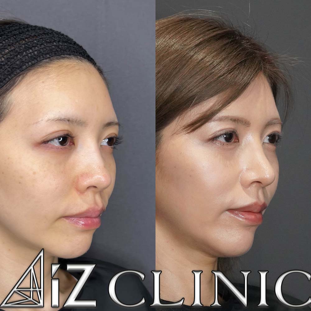 鼻尖形成ストラット法、軟骨移植、鼻中隔延長、プロテーゼ取り出し、人工真皮の術後3ヶ月