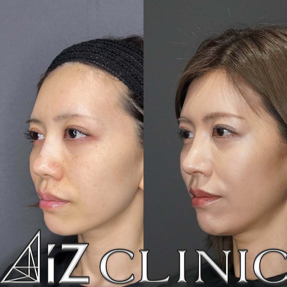 鼻尖形成ストラット法、軟骨移植、鼻中隔延長、プロテーゼ取り出し、人工真皮の術後3ヶ月