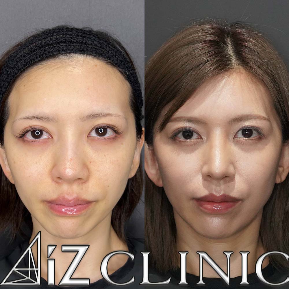 鼻尖形成ストラット法、軟骨移植、鼻中隔延長、プロテーゼ取り出し、人工真皮の術後3ヶ月