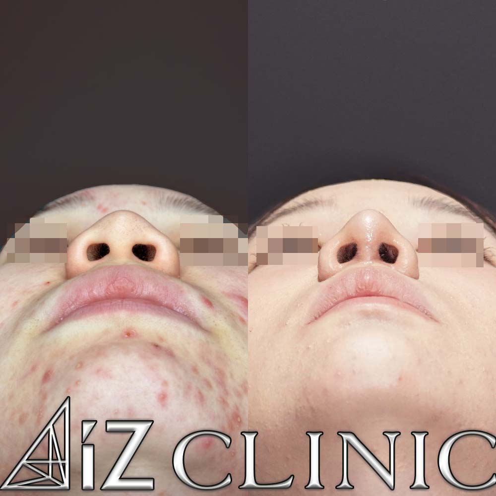 鼻柱下降により鼻柱をしっかりだし鼻を長くした症例