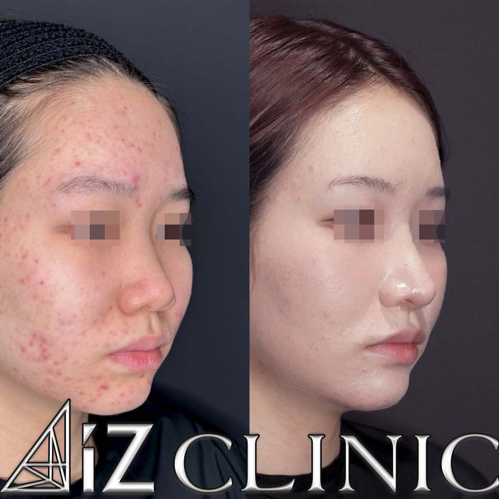 鼻柱下降により鼻柱をしっかりだし鼻を長くした症例