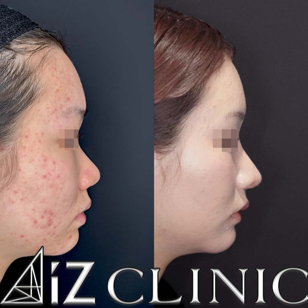 鼻柱下降により鼻柱をしっかりだし鼻を長くした症例