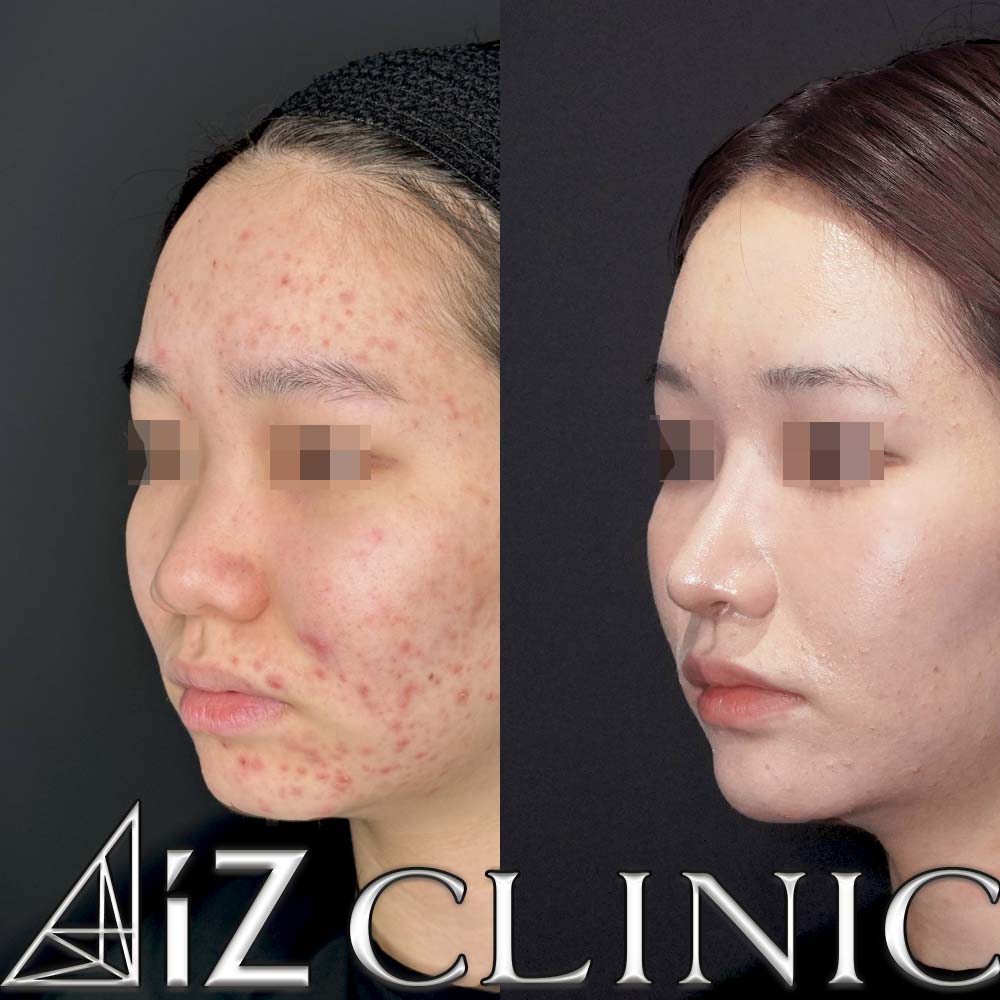 鼻柱下降により鼻柱をしっかりだし鼻を長くした症例