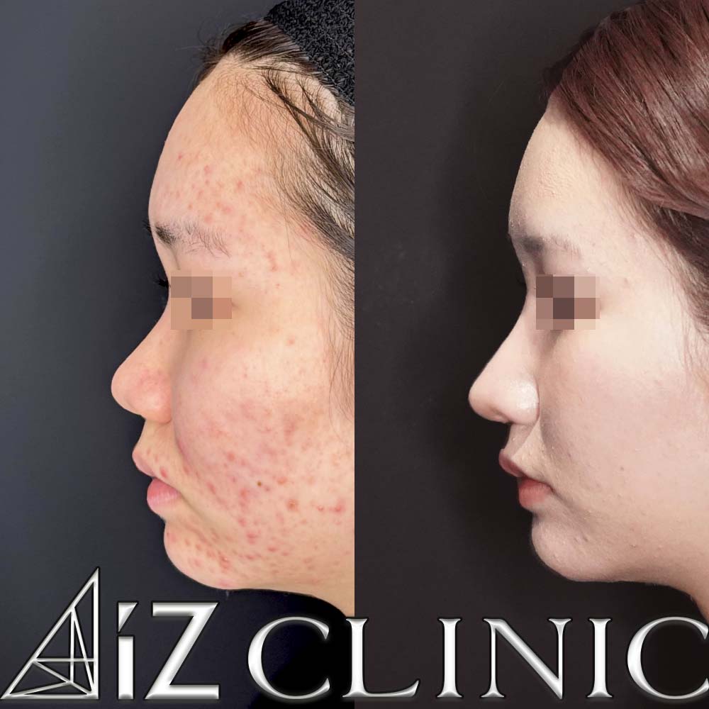 鼻柱下降により鼻柱をしっかりだし鼻を長くした症例